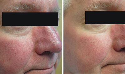 Symptoms and Treatment of Rosacea