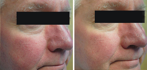 Rosacea Treatment