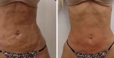 Surgical and Non-Surgical Body Contouring