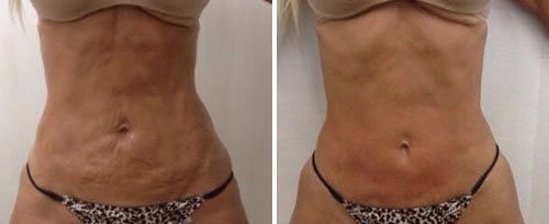 TightSculpting Fat Reduction & Body Contouring