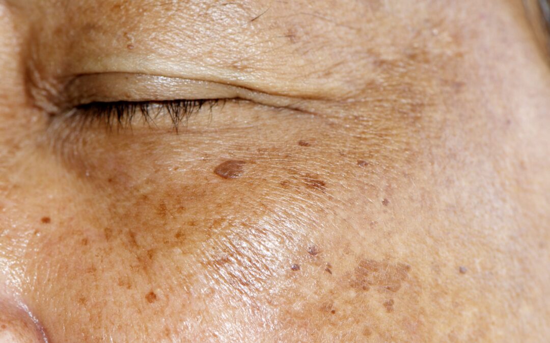 Melasma Causes and Treatment