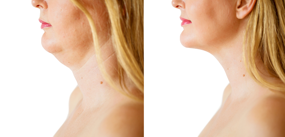 How to reduce a double chin