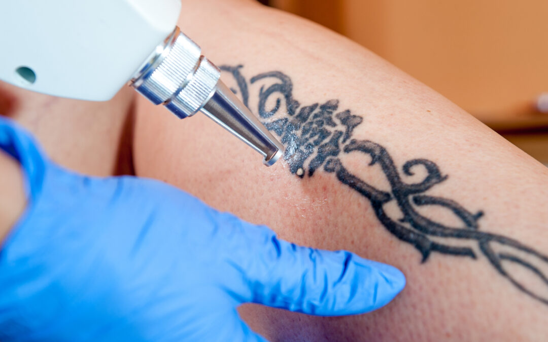 Tattoo Removal