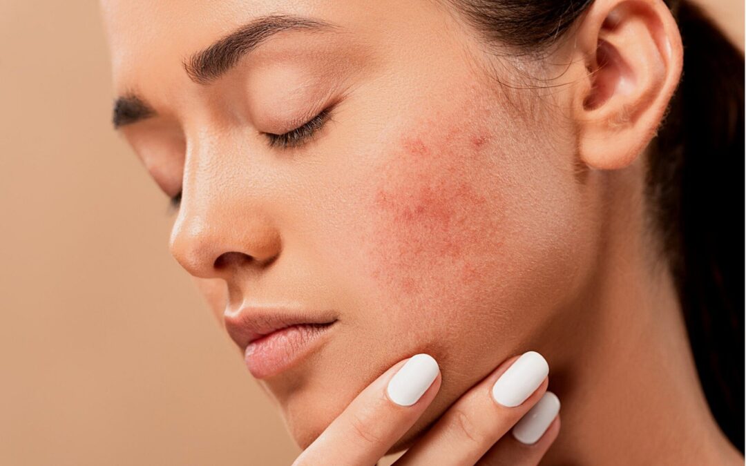 How to get rid of Acne Scars