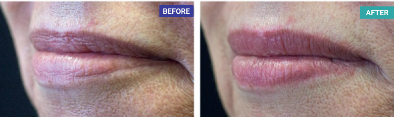 Non-Injectable Lip Plumping