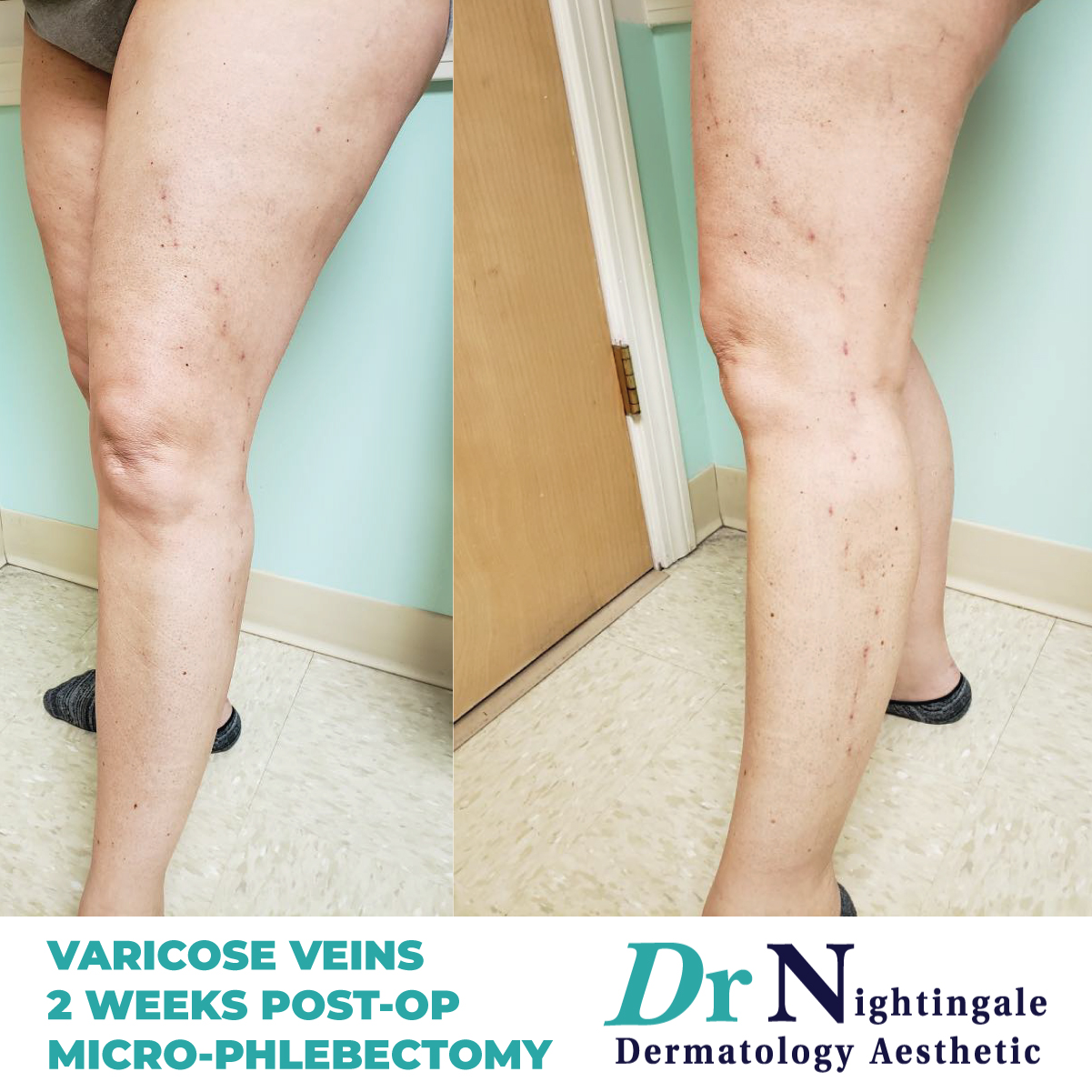 Vein Treatment in Maine and Vermont