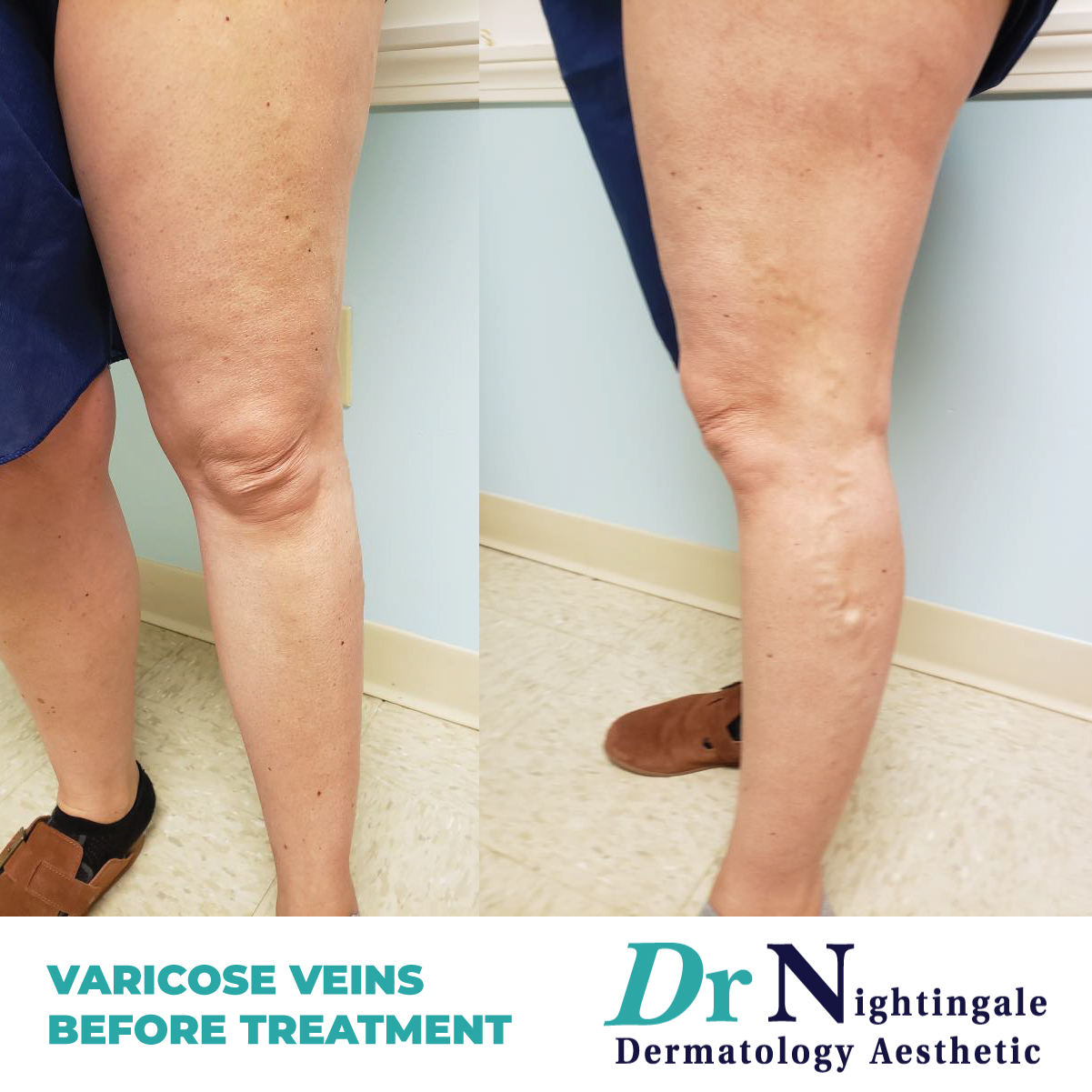 Varicose Veins