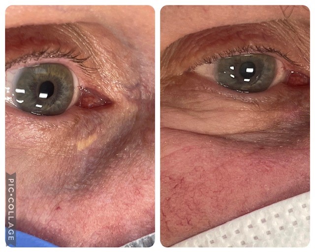 laser-skin-lesion-removal.jpg