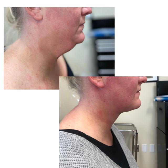 Syringe Liposculpture before and after