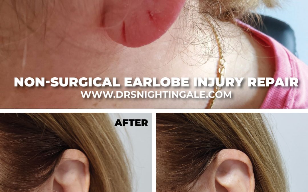 Non-surgical earlobe repair with Fotona Dynamis laser