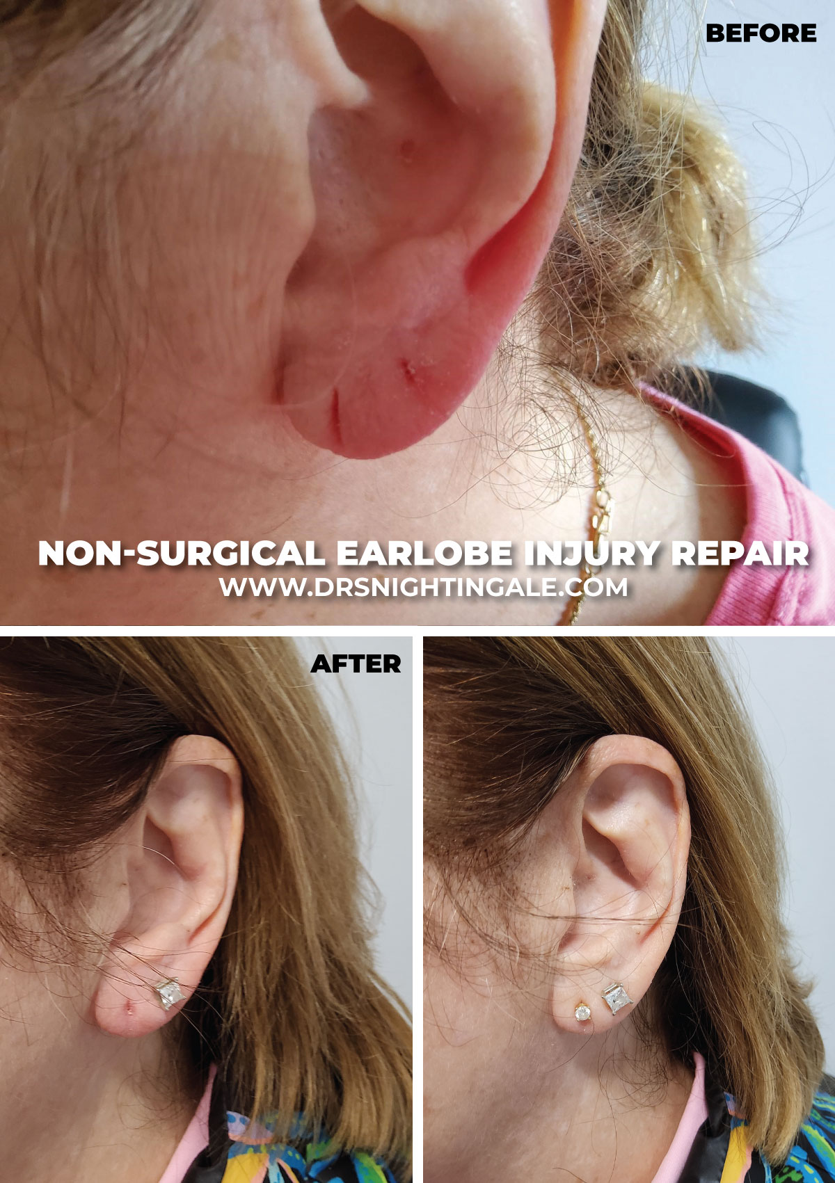 Non-surgical earlobe injury repair with Fotona Dynamis laser