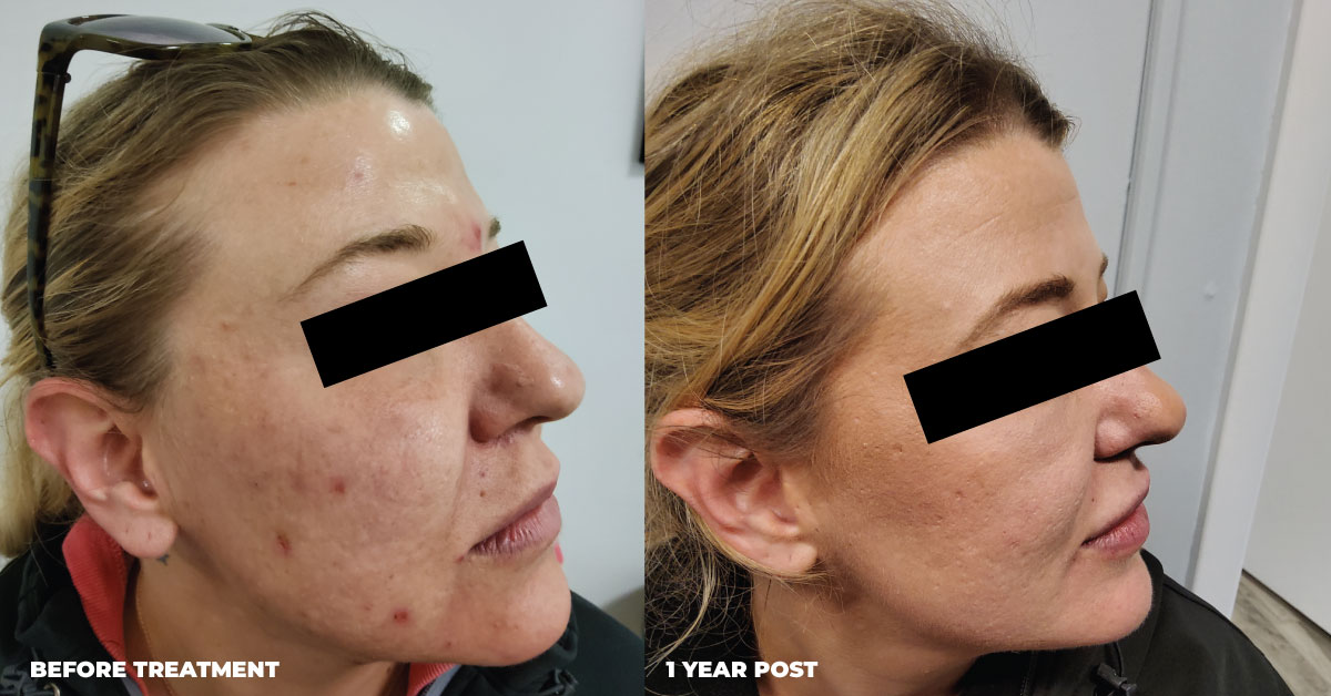 Acne Treatment Before & After Side View
