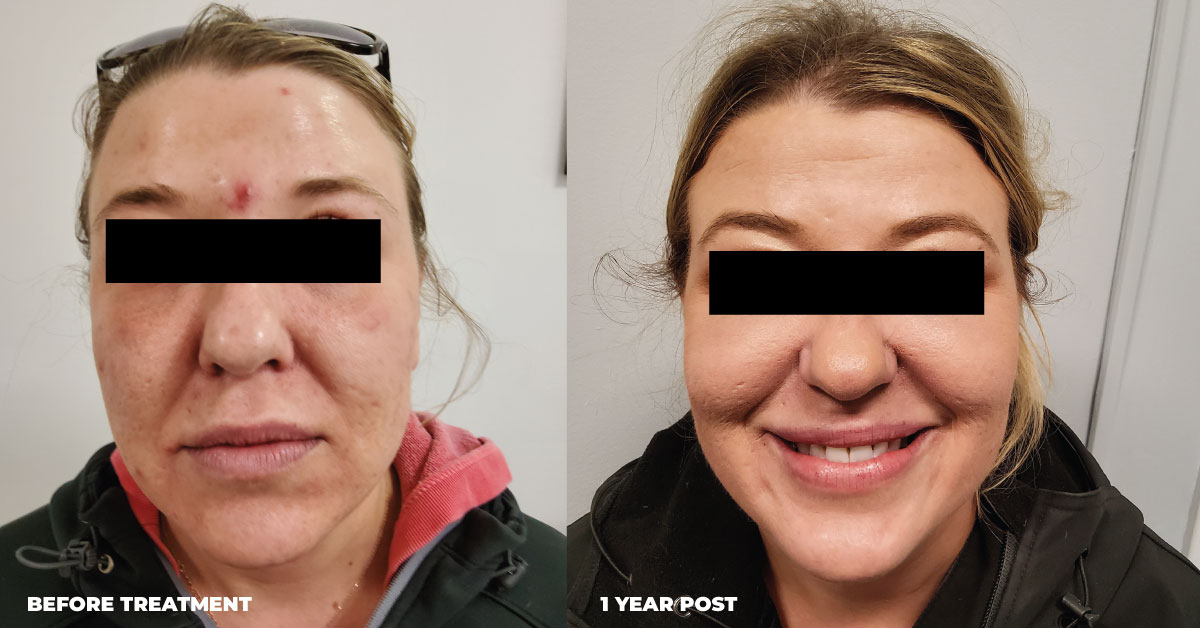 dr-n-acne-treatment Acne Treatment Before & After