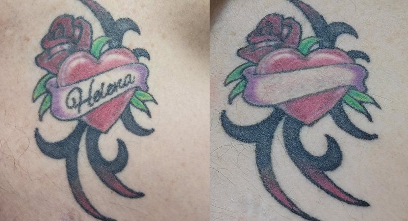 Laser Tattoo Removal in Ellsworth Maine and Essex Vermont