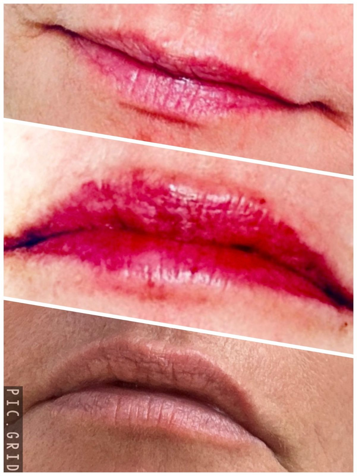 Filler Vobella and  conservative lip augmentation results. 