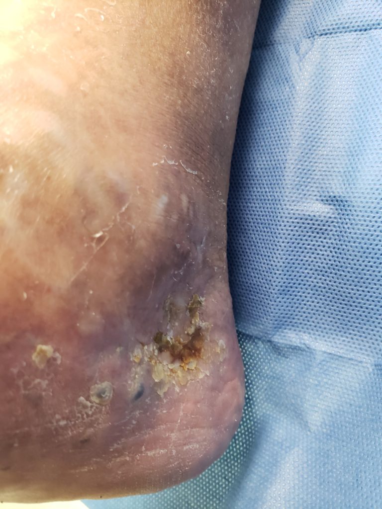 Venous ulcer & stasis dermatitis - before treatment