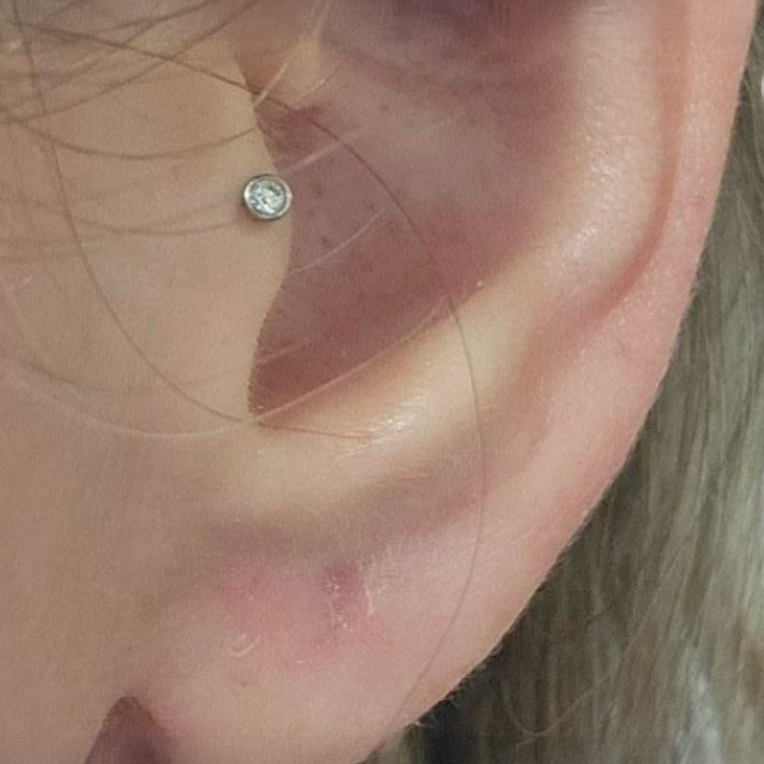after Non-surgical Earlobe Hole Repair - After