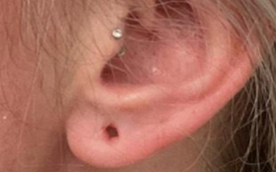 Non-Surgical Earlobe Injury Repair