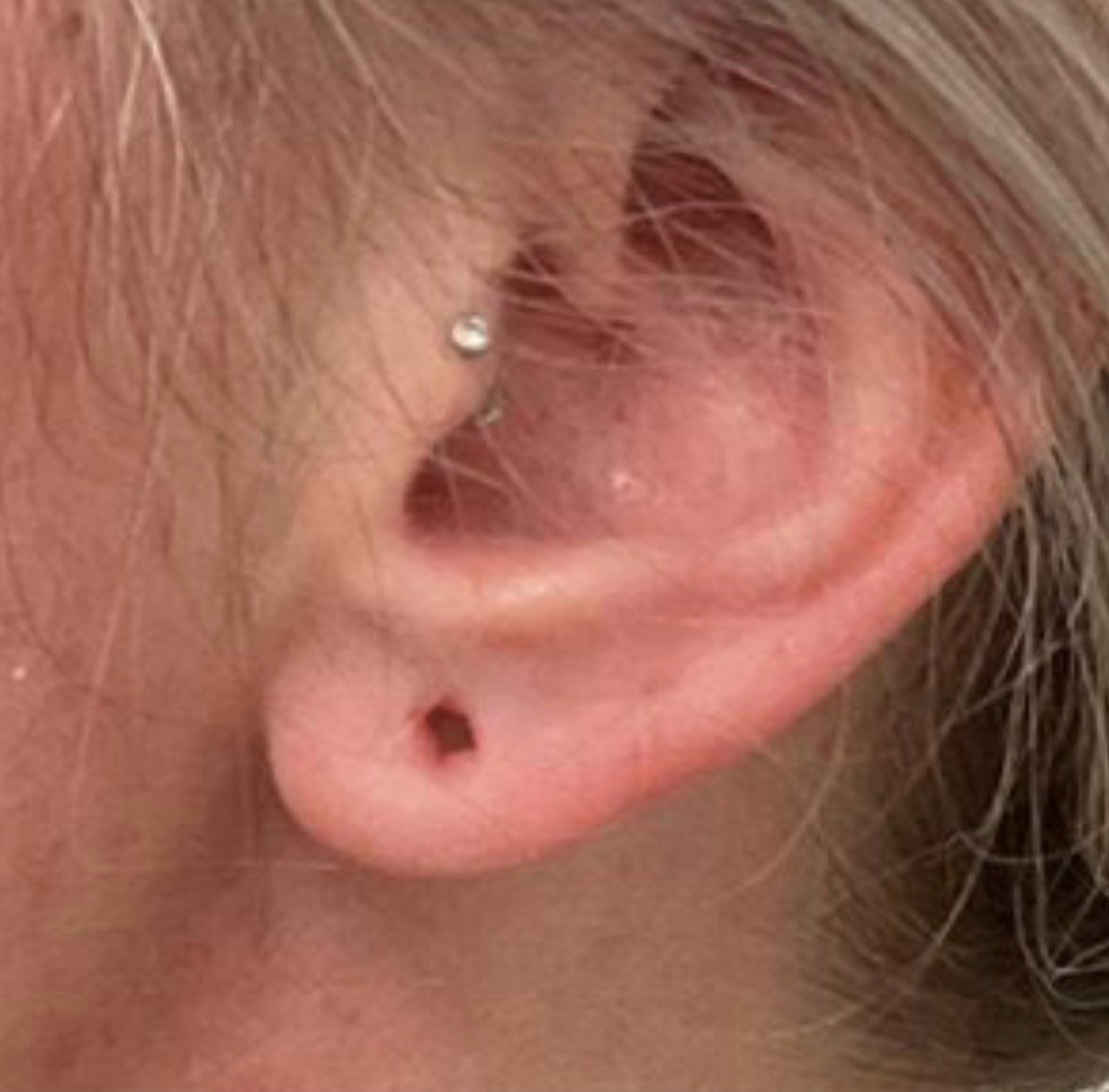 before Non-surgical Earlobe Hole Repair - Before